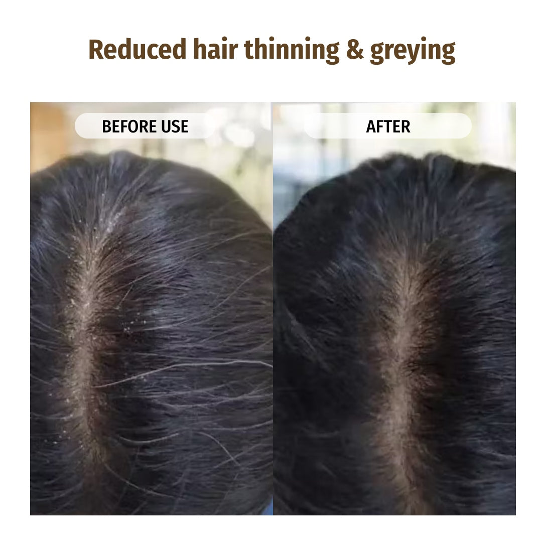 Anti-dandruff Combo