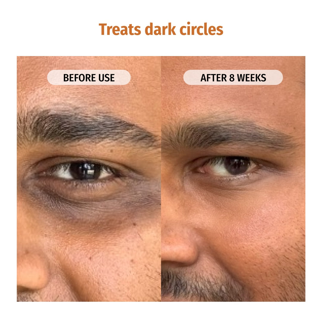 Vilvah Under Eye Cream Treats Dark Circles
