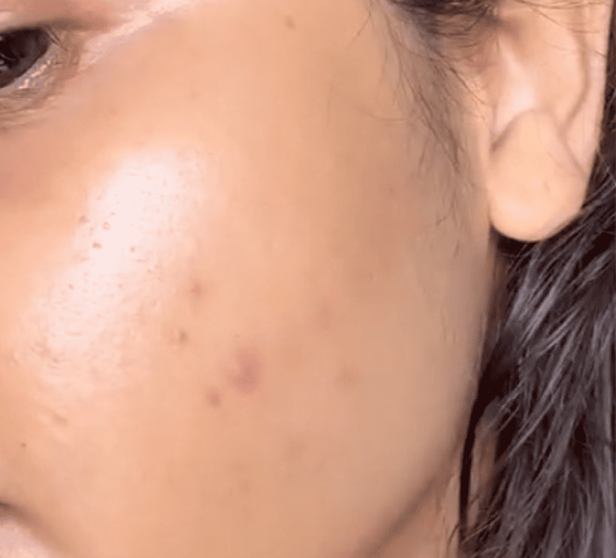 after using vilvah milk drop serum