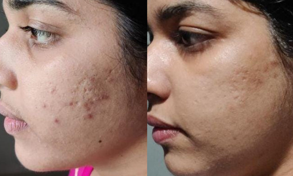 Before and after using aloe vera gel - Vilvah