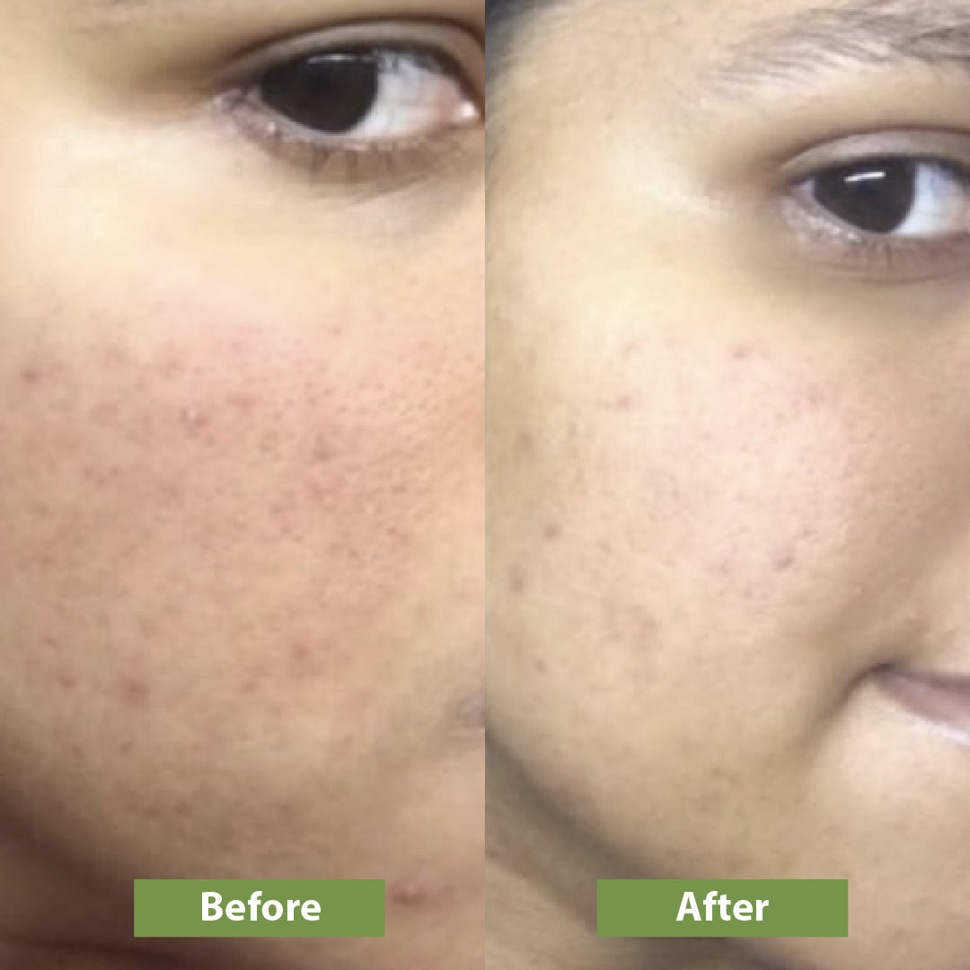 Before and after using aloe vera gel - Vilvah