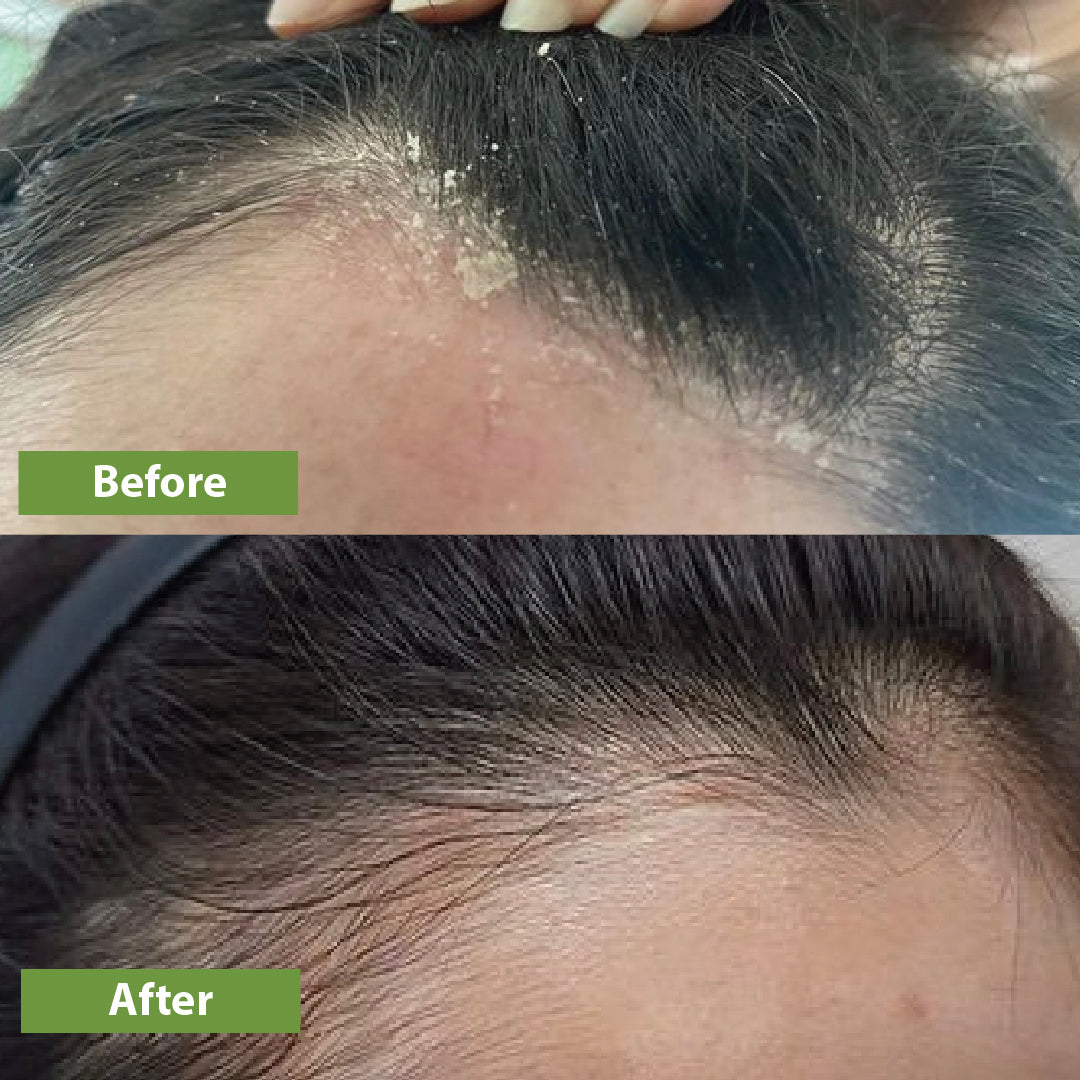 Before and after using Vilvah's anti-dandruff hair oil