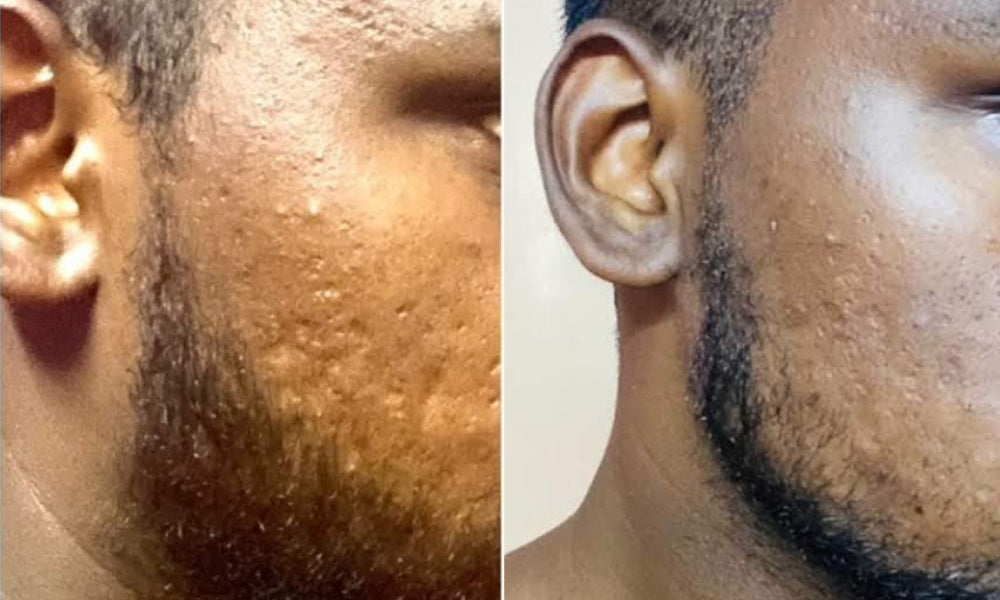 Before and after using Vilvah's charcoal face mask