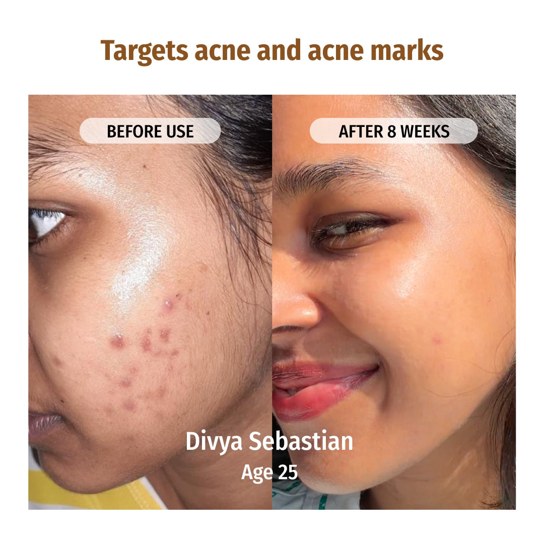 vilvah face brightening combo targets acne and acne marks