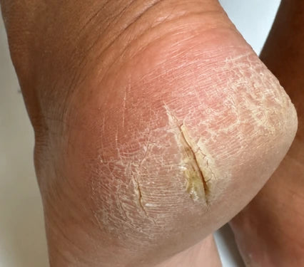 foot crack