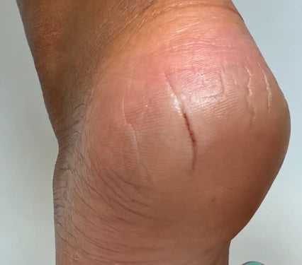 foot crack