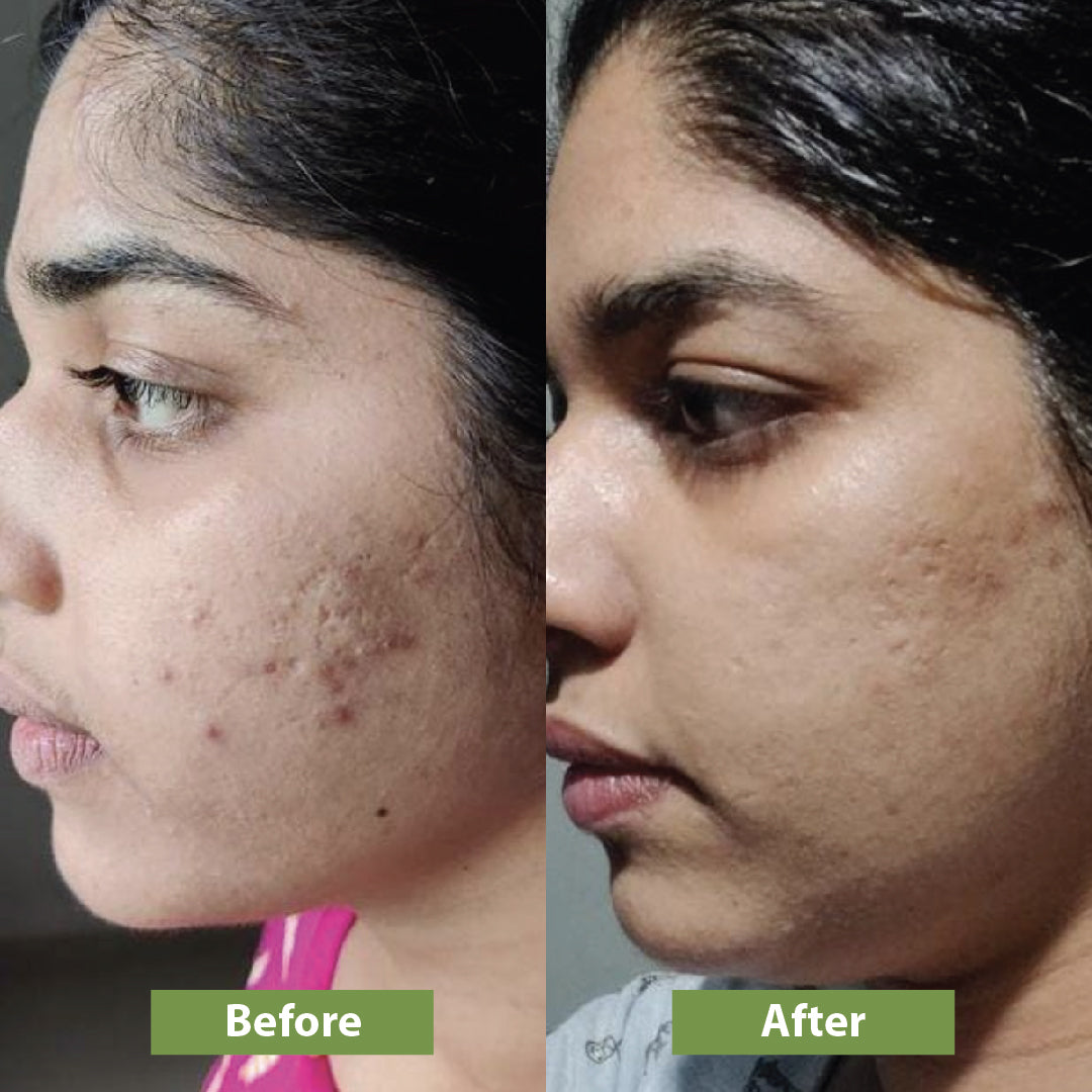 Before and after using Vilvah's honey fix face wash