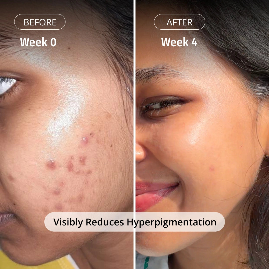Vilvah Milk Drops Serum reduces Hyperpigmentation