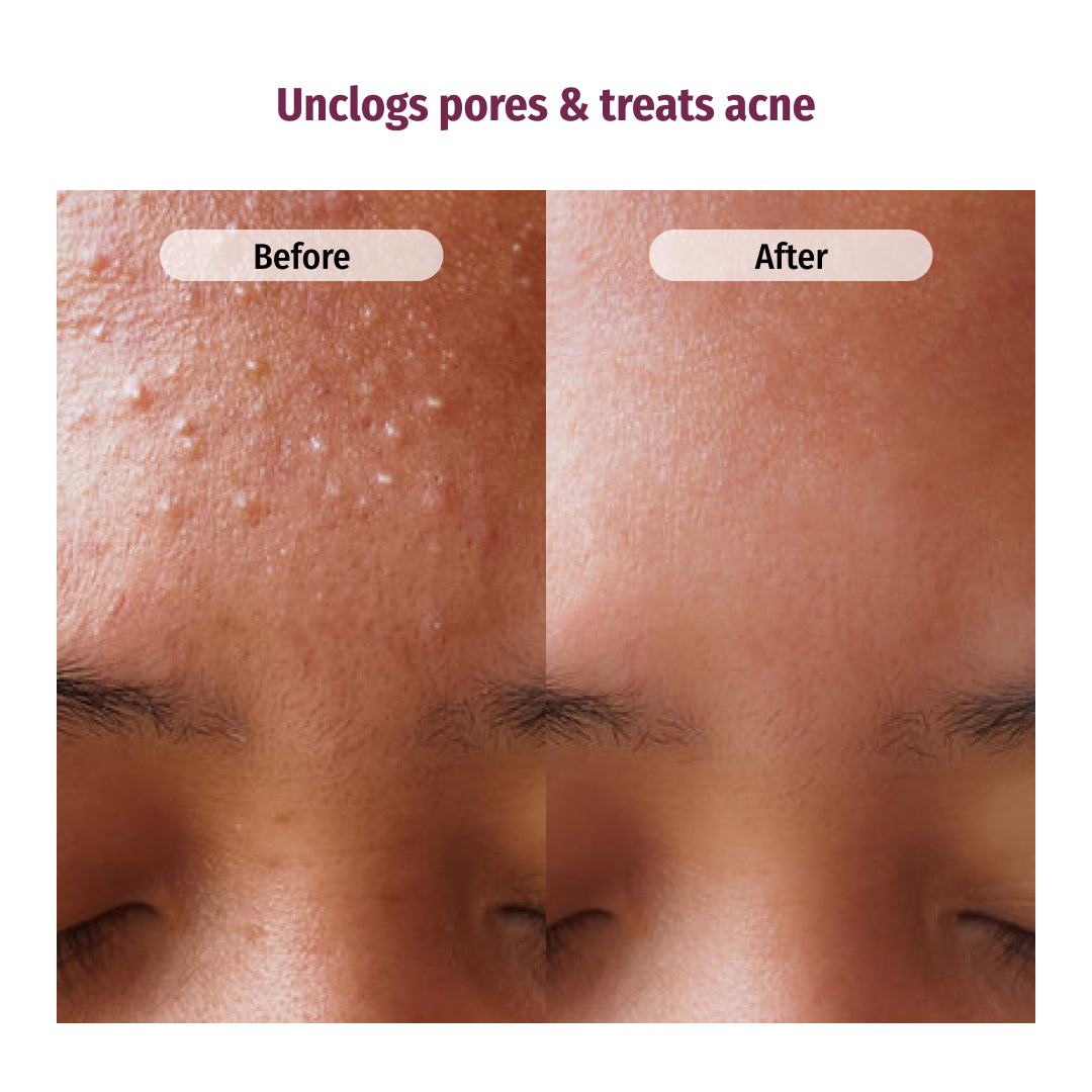 vilvah rose water facial toner unclogs pores and treats acne