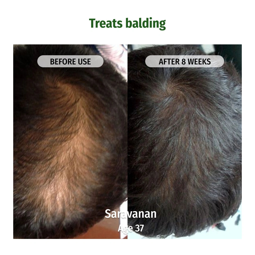 Vilvah Grow & Repair Combo treats Balding