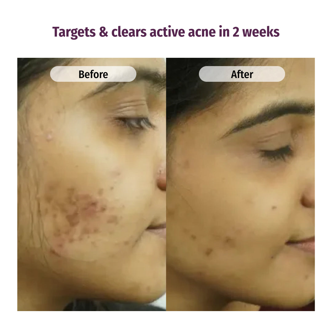 vilvah honey fix face wash targets and clears active acne