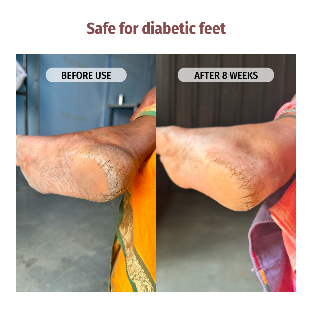 vilvah foot cream safe for diabetic feet