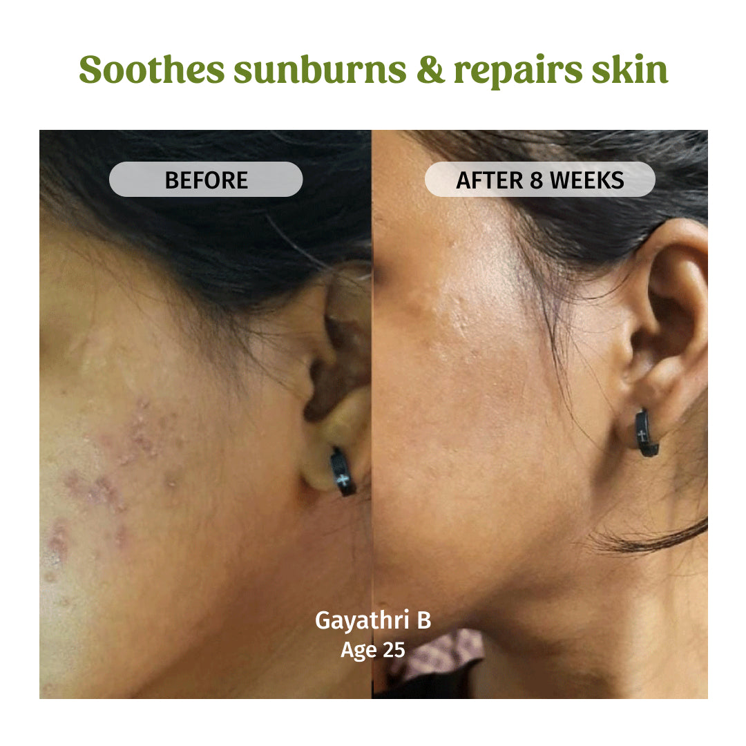 vilvah aloe vera gel soothes sunburns and repairs skin