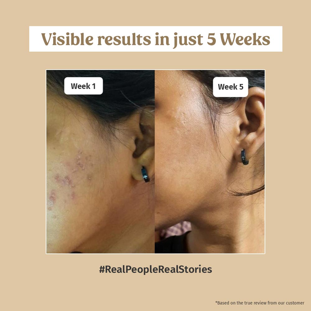 Before and after using Vilvah's skin brightening combo