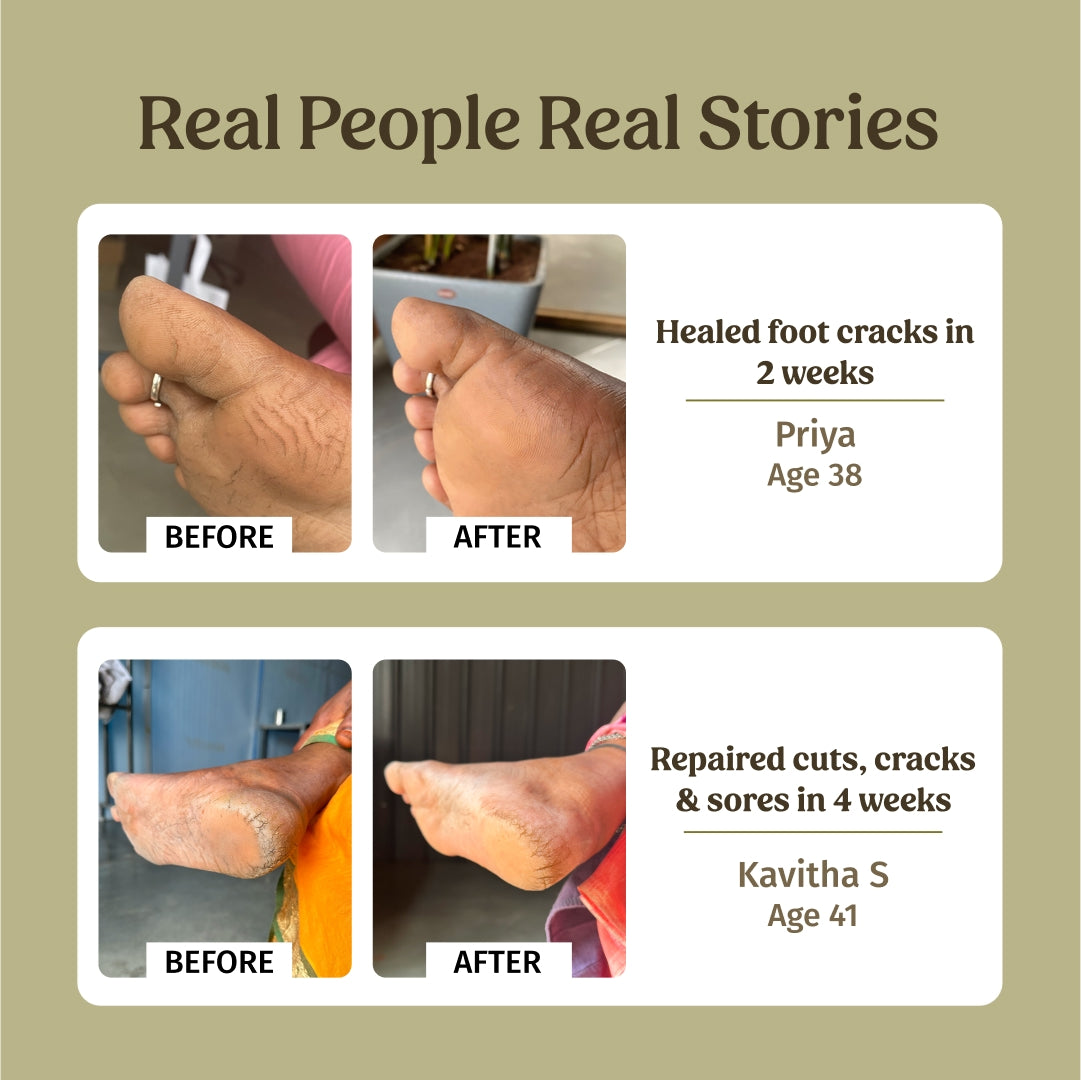 before and after using foot crack cream - Vilvah